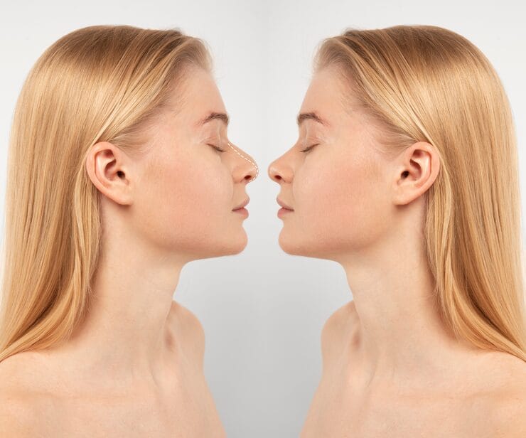 revizyon rinoplasti ameliyat süreci